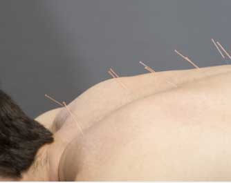 Acupuncteur Audrey Brochard 